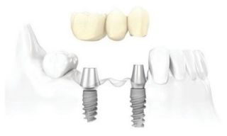implantology trainings honolulu Honolulu Periodontics + Implants: Top Dental Implant Providers