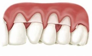 Cosmetic Periodontal Surgery