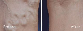 varicose veins clinics honolulu Aloha Vein