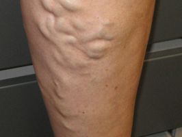 varicose veins specialists honolulu Aloha Vein