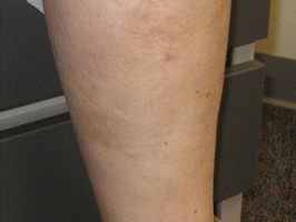 varicose veins specialists honolulu Aloha Vein