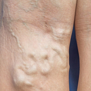 varicose veins clinics honolulu Aloha Vein